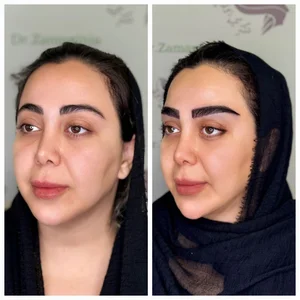 کاشت ابرو صفر تا صد | فیلم مراحل کاشت طبیعی ابرو بهترین متخصص کاشت