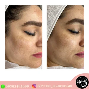 بیوتی تراپیست الهه حصاری