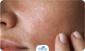 چه چیزی برای پوست دهیدراته خوبه؟
