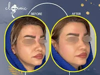 تزریق ژل گونه (مزایا، مراحل و کاربردها) - کلینیک مهرافروز