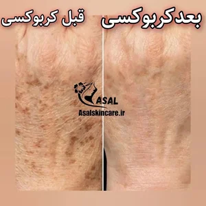 خدمات تخصصی پاکسازی پوست عسل 4
