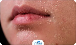 پوست دهیدراته یا کم آب چیست؟ روتین مراقبت + روش‌های درمان