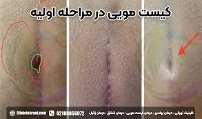 تشخیص کیست مویی | 9 علائم کیست مویی + عکس مراحل اولیه