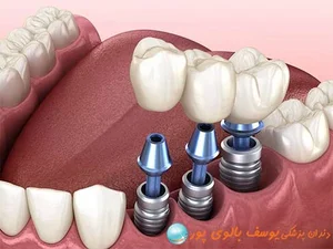 دندانپزشکی و مرکز ایمپلنت دکتر امیر شهریار