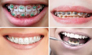 بهترین روش ارتودنسی کدام است؟ | معرفی مدل ارتودنسی های جدید