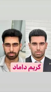 پیرایش مروارید