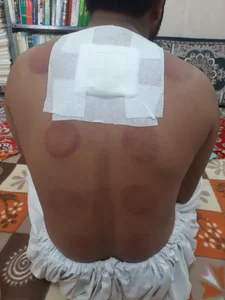 حجامت درمانی 2
