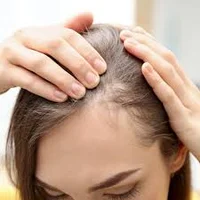 دلایل ریزش مو شدید در زنان و مردان کدامند؟ | درمان ریزش موی سر ...