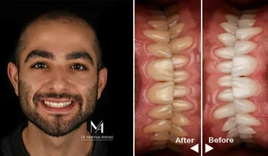 بلیچینگ دندان برای چه کسانی مناسب است؟ - دکتر مهناز ارشد