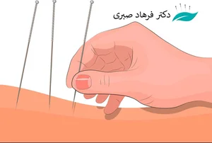 طب سوزنی استاد مرادی نژاد