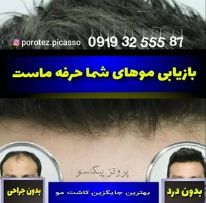 پروتز مو پیکاسو