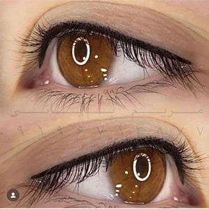 میکروبلیدینگ زنجان فیبروززنجان 3