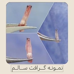 کاشت تخصصی موی طبیعی شهلا 2