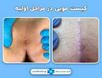 کیست مویی؟