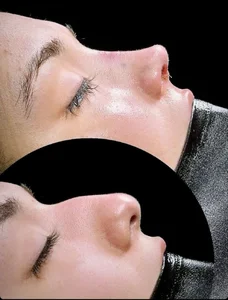 جراحی بینی غزل گودرزی 2