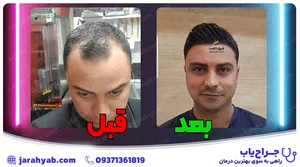 کاشت ابرو