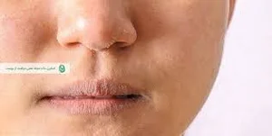 پوست دهیدراته؛ علت دهیدراته شدن پوست ، درمان، پیشگیری و معرفی ...