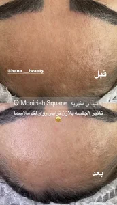 فیشال و پاکسازی پوست حنانه وقاری 4