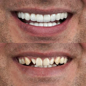 کامپوزیت و لمینت دندانپزشکی دکتر داور خاطری
