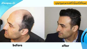 زراعة الشعر والليزر بایدار