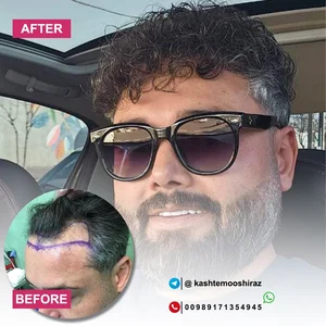 مرکز کاشت مو حسینی 3