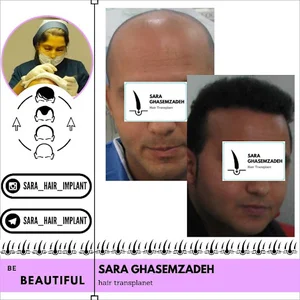 کاشت مو قاسم زاده