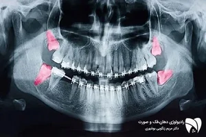رادیولوژی دهان، فک و صورت نوین پرتو(دکتر سارا واعظی)