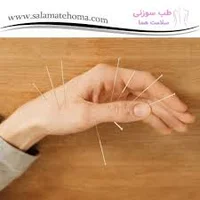 طب سوزنی خانم کریمی