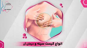 انواع کیست سینه و راه های درمان آن - دکتر مهسا توکل