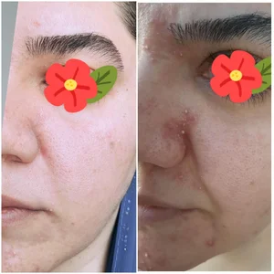خدمات پاکسازی فیشال پوست 2