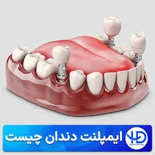 مرکز تخصصی ایمپلنت و پروتزهای دندانی، دکتر رضا شاکر