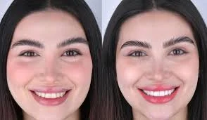 لمینت دندان یا کامپوزیت؟ مقایسه تفاوت‌ها، مزایا و معایب