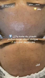 فیشال و پاکسازی پوست حنانه وقاری 5