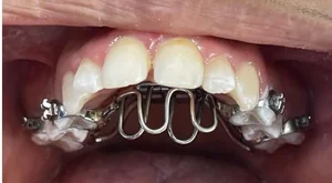 لابراتوار تخصصی ارتودنسی حبیبی (سازنده تخصصی اورال اپلاینس یا دستگاه دهانی خروپف) 4