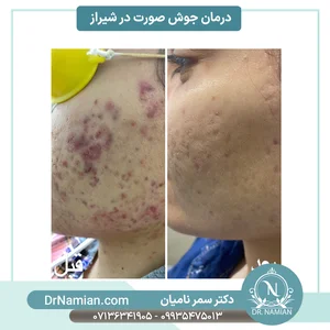 درمان جوش صورت در شیراز و بهترین روشهای آن - دکتر نامیان