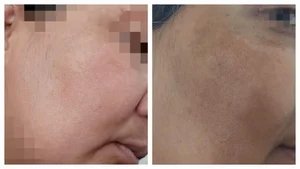 خدمات پاکسازی فیشال پوست