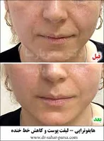 هایفو و جوانسازی