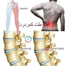علت کمر درد | چرا کمردرد می‌گیریم | چرا کمر درد به پا میزند