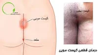 درمان قطعی کیست مویی - دکتر زهرا سعادتی متخصص جراحی و لیزر