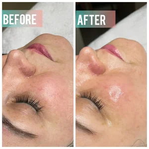 خدمات پاکسازی پوست و فیشال آرمی 5