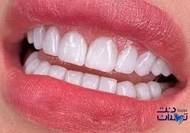 لمینت دندان چیست؟ - لابراتوار دندانسازی و میلینگ سنتر تهران دنت