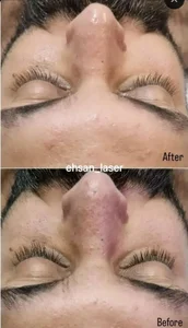 لیزر وفیشال آقایان احسان 3