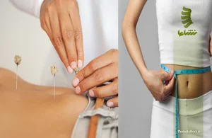 طب سوزنی محمدی