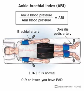 Ankle-Brachial Index: Test & What It Means