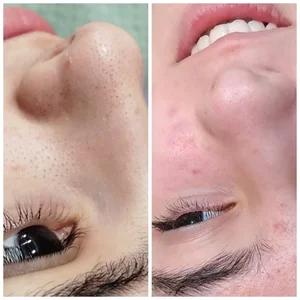 پاکسازی پوست بخشی