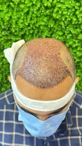 کلینیک کاشت مو و ابرو محبوبه ابراهیمی