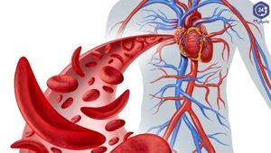 کم خونی ناشی از فقر آهن چیست و چگونه می‌توان از آن پیشگیری کرد ...