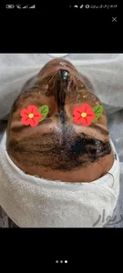 خدمات پاکسازی فیشال پوست 4