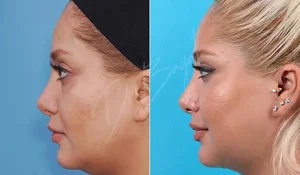 پروتز گونه| قیمت جراحی پروتز گونه 💢هزینه تابستان 1404