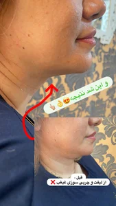 لاغری موضعی سعادت 4